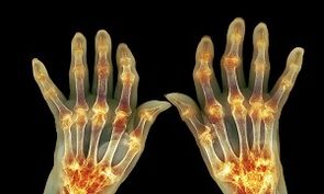 Eklemlerin artrozundan artrit arasındaki fark nedir