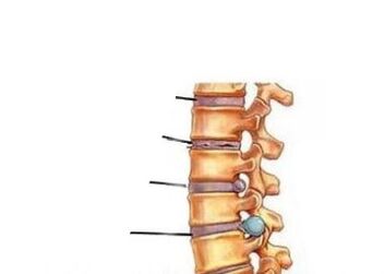 Osteokondroz gelişiminin dört aşaması