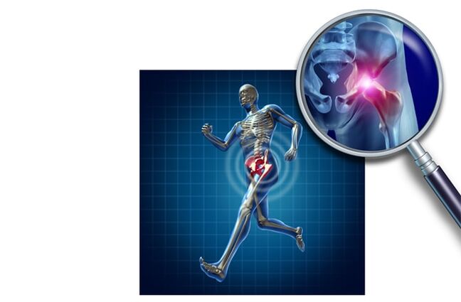 Kalça ekleminde koşarken ağrı